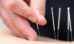Traditional Acupuncture Treatment